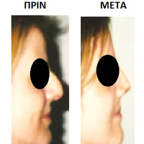 Επέμβαση 13