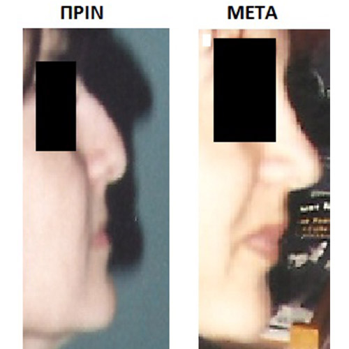 Επέμβαση 16