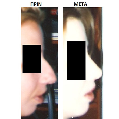 Επέμβαση 5