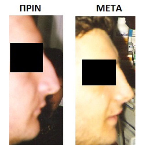 Επέμβαση 6
